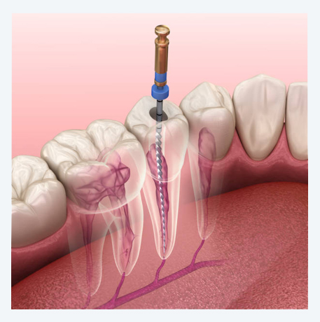 Endodoncia en Los Olivos