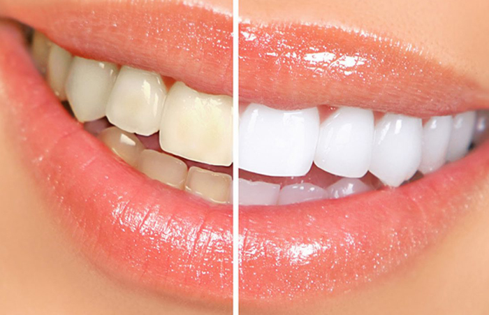 Blanqueamiento Dental en Los Olivos