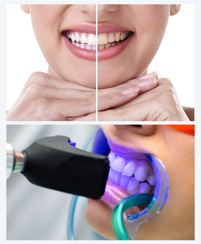 Blanqueamiento Dental en Los Olivos