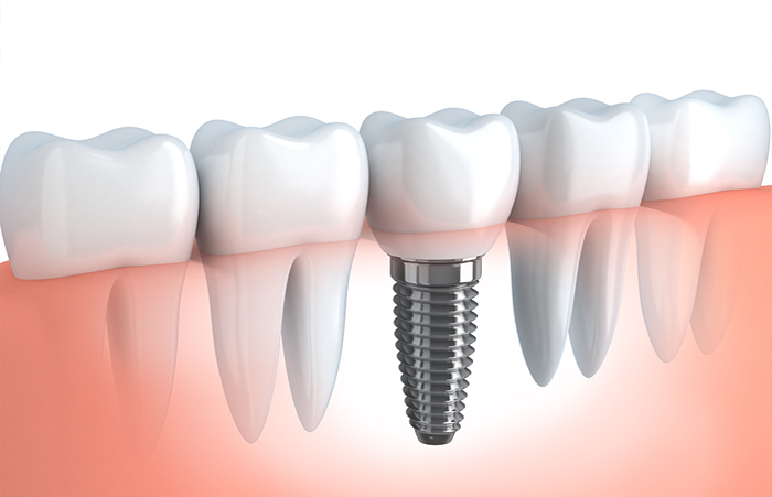 Implantes Dentales en Los Olivos