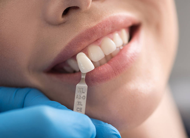 Implantes Dentales en Los Olivos