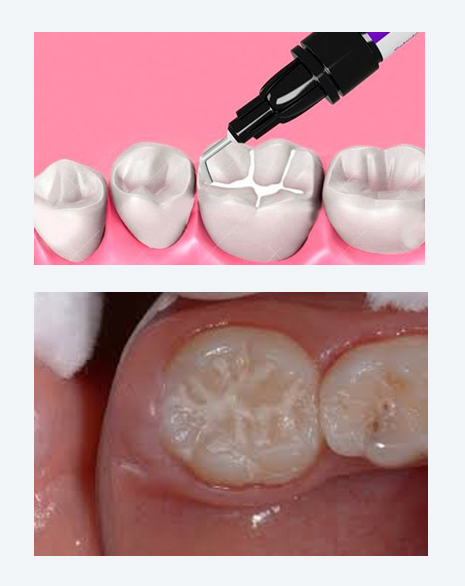 Operatoria Dental