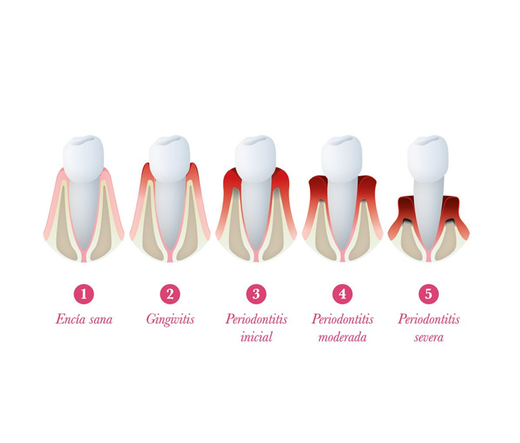 Periodoncia en Los Olivos
